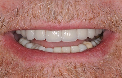 Smile with dnetal implant retained hybrid full arch denture