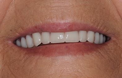 Perfected smile after dental implant retained denture placement