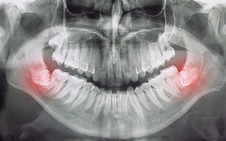 X-ray with only 2 wisdom teeth highlighted in red in lower arch