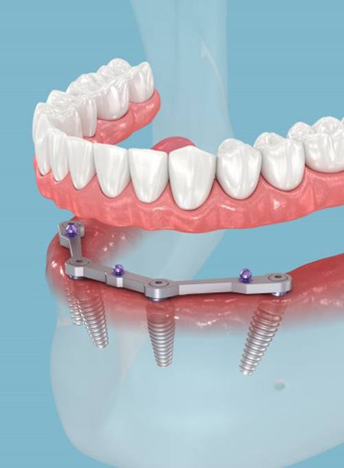 Digital illustration of an all-on-4 prosthetic