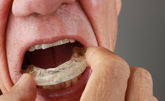 An older man putting a nightguard in his mouth