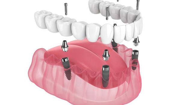 Illustration of implant dentures