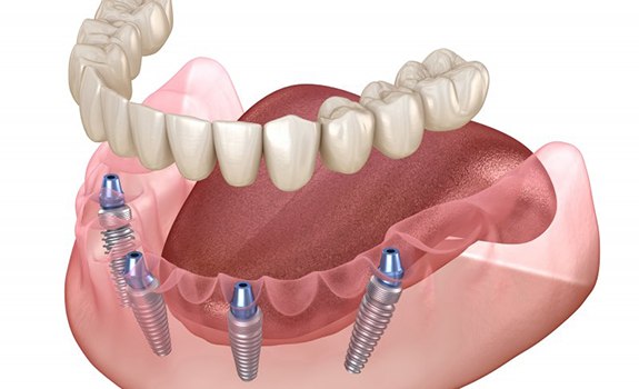 Illustration of implant dentures