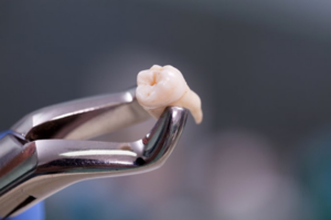 Close up of a wisdom tooth